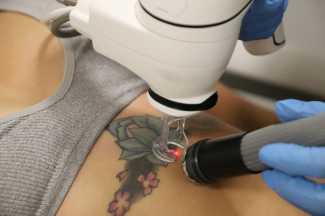 Erase Your Ink with Laser Tattoo Removal