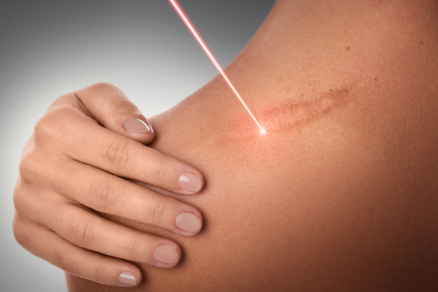 Comprehensive Guide to Keloid Scar Removal in London: Costs, Treatments, and Expert Surgery Options in the UK