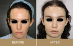 Chin Reduction Or Recontouring Surgery for Feminizing The Face