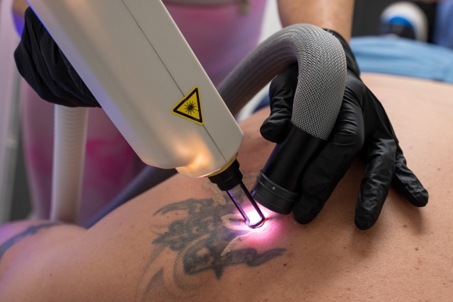 Transform Your Skin with Laser Tattoo Removal