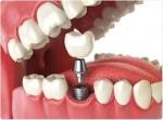 •  The Role of Bone Grafting in Dental Implants