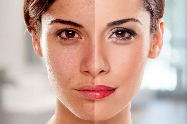 Are Permanent Skin Whitening Treatments in Dubai Worth It? Key Considerations and Tips