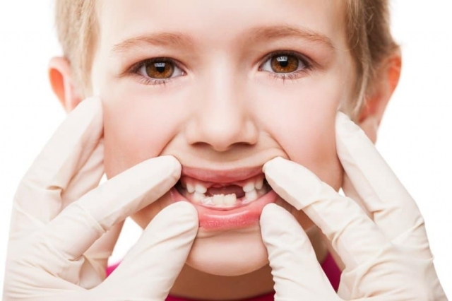 What Are the Most Affordable Options for Tooth Fillings in Dubai? Cost-Saving Strategies