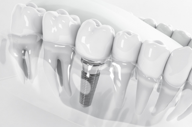 10 Myths Debunked About Single Tooth Implants