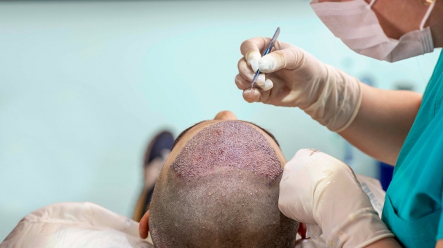 Say Goodbye to Hair Loss: Top Hair Transplant Surgeons in Dubai