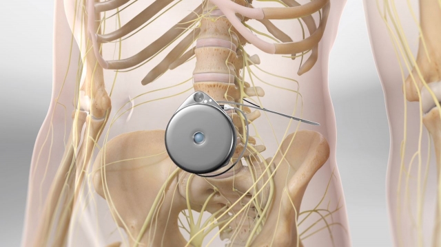 Intrathecal Pumps Market Size and Growth Forecast : Top Manufacturers