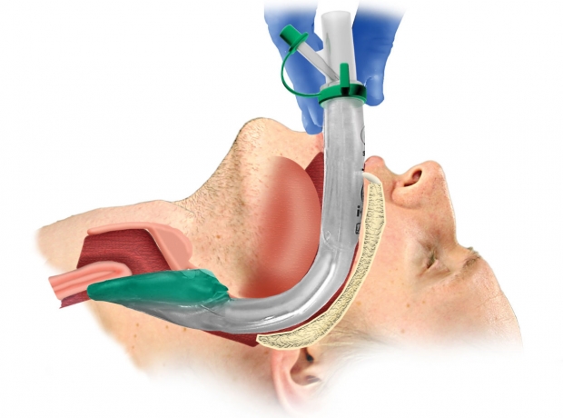 Supraglottic Airway Devices Market Size and Growth Forecast