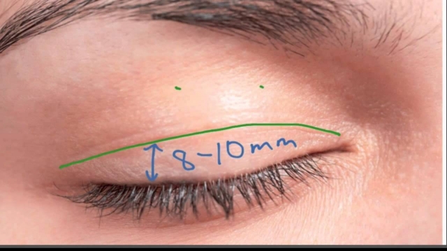 Discover the Secret to Youthful Eyes with the Best Eyelid Surgery Doctor in Riyadh