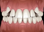 MISALIGNED TEETH