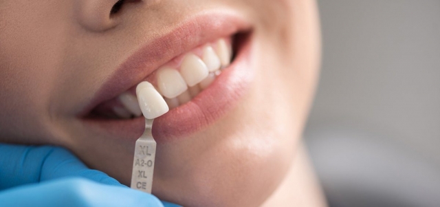 How Much Do Dental Fillings Cost in Riyadh? Your Essential Breakdown