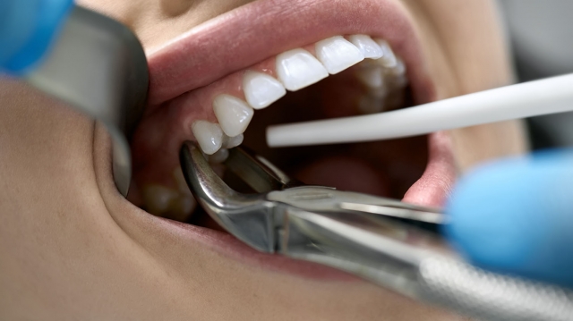 What Healing Tips Should You Follow After a Tooth Extraction in Dubai?