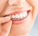 Invisible Orthodontics Market Size and Growth Forecast : Top Manufacturers