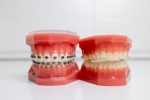 Invisalign vs. Braces- Which One Should Your Smile Go For?