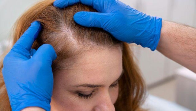 What to Expect When Starting Finasteride for Hair Loss in Dubai