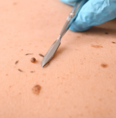 Top Skin Tag Removal Treatments: Safe and Effective Methods Revealed