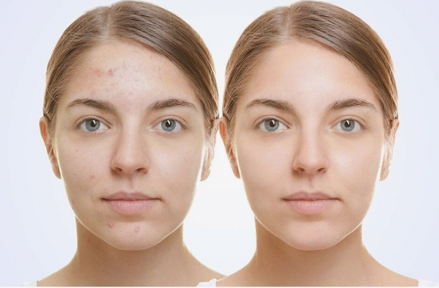Banish Acne for Good: The Power Duo of Salicylic and Glycolic Acid Serums
