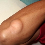Lipoma Treatment: Your Guide to Smooth Recovery