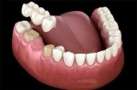 Understanding Dental Bridge Services: A Comprehensive Guide