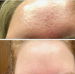 Salicylic Acid Body Wash: Your Solution to Breakouts and Bumps