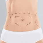 The Role of Technology in Modern Tummy Tuck Clinics
