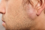 Top Lipoma Treatment Methods for Quick Relief