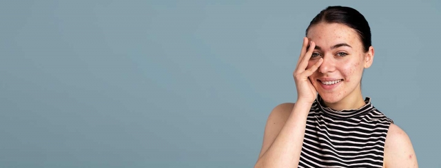 Will Acne Scars Fade Over Time?