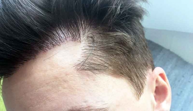 Is Hair Transplant Cost: What You Need to Know Now