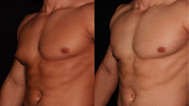 Why Gynecomastia Surgery in Dubai Is Popular Among Young Professionals
