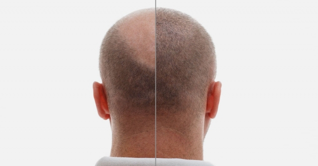 FUE Hair Transplant: Experience the Full Hair Effect