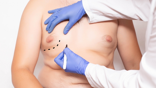 Transform Your Look with Gynecomastia Surgery