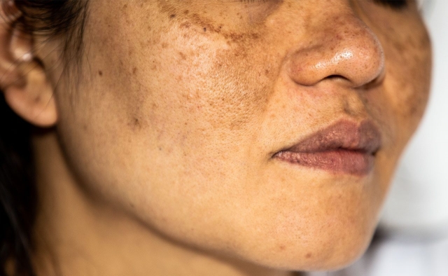 Understanding the Emotional Aspects of Melasma and Treatment in Dubai