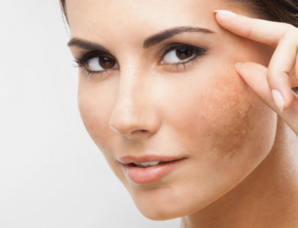 How Kojic Acid Cream Can Help with Melasma and Sun Damage