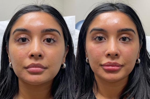 Best Clinics for Dermal Fillers Near Me in Chesterfield