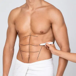 Is Liposuction Right for You? Factors to Consider in Dubai