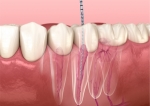 Eco-Friendly Practices in Root Canal Treatments in Dubai