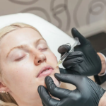 Best Marionette Lines Treatment in Marylebone, London