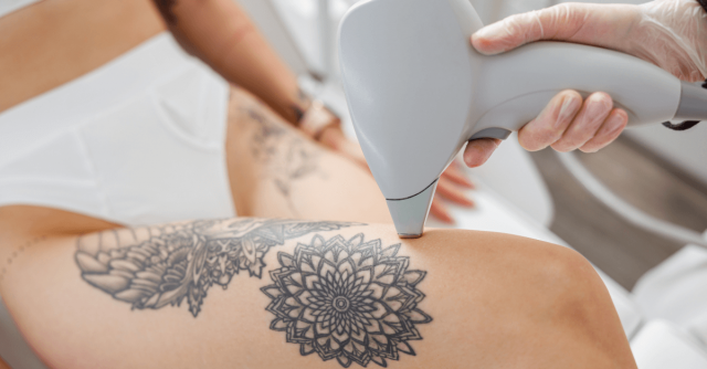 Preparing for Laser Tattoo Removal: Dubai’s Checklist