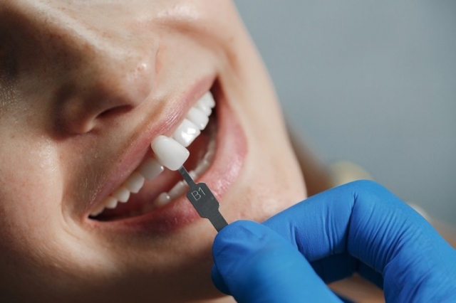 Luxury Smile Makeovers: Dental Veneers in Dubai's Best Clinics