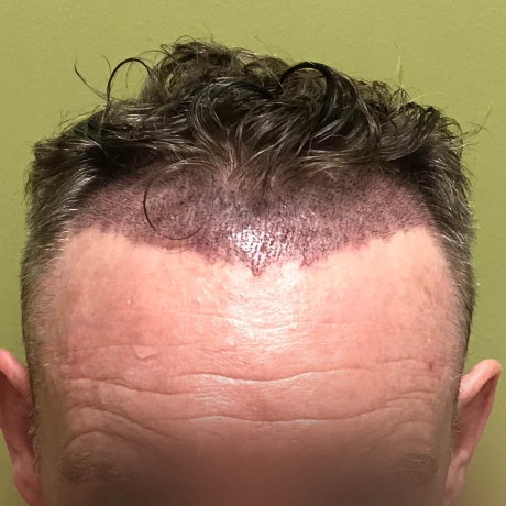 Aftercare Tips for FUE Hair Transplant Success
