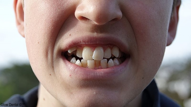 The Best Ways to Treat Crowded Teeth in Dubai: Solutions for Every Smile