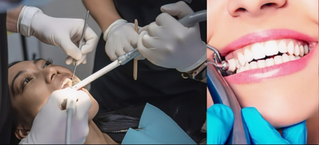 Best Tooth Filling in Brooklyn – Types, Cost & Insurance Options