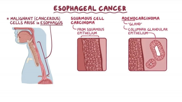 Esophageal Squamous Cell Carcinoma Market Size, Share, Trends, Industry Report 2024-34