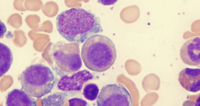 Current State of U.S., Europe, and China Myelodysplastic Syndrome (MDS) Treatment 