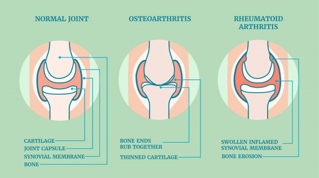 Rheumatoid Arthritis Market Size, Industry Trends, Growth 2024-34