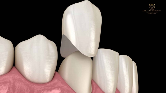 Discovering New Dental Crown Services For A Beautiful Smile