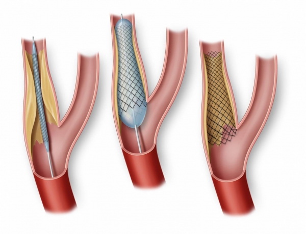 Carotid Stents Market: A Comprehensive Study