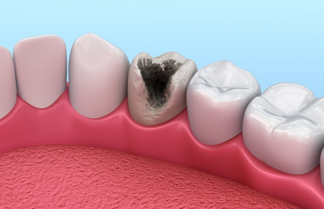 Dental Caries Treatment Market Driven by Increasing Incidence of Tooth Decay