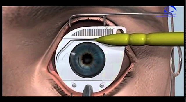 Refractive Surgery Industry is witnessing Advancements in LASIK Treatments
