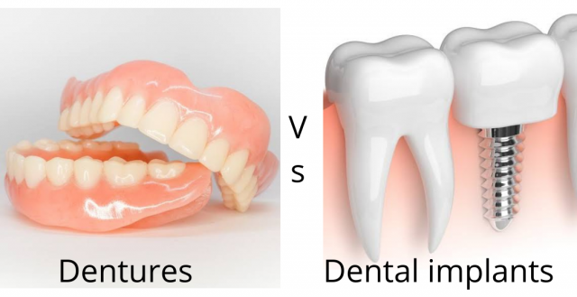 Dentures vs. Dental Implants: Which Is the Best Option for You?