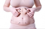Get Outstanding Results with Riyadh’s Premier Liposuction Clinics